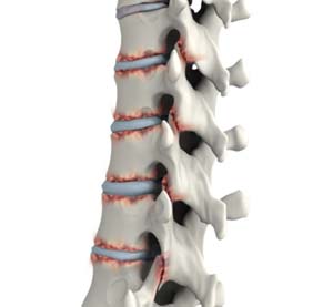 Ankylosing Spondylitis