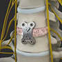 Anterior Cervical Discectomy and Fusion