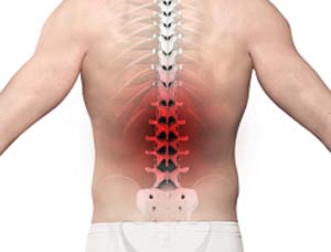 Low Back Pain