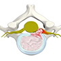 Herniated Disc (Cervical)