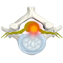 Cervical Disc Protrusion