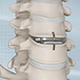 Cervical Disc Replacement