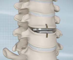 Cervical Disc Replacement<