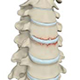 Cervical Fracture