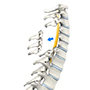 Cervical Laminectomy