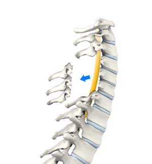 Cervical Laminoplasty