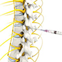 Epidural Steroid Injections