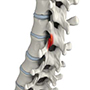 Facet Joint Arthritis