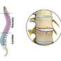 Osteoarthritis of the Hip 