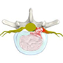 Herniated disc (Lumbar)