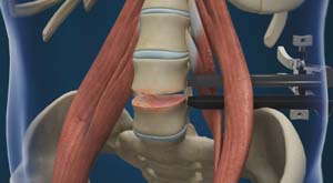 Lumbar Discectomy