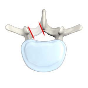 Lumbar Foraminotomy