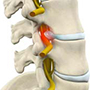 Lumbar Radiculopathy