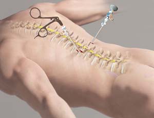 Minimally Invasive Spine Surgery