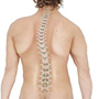 Scoliosis