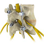 Spinal Fusion