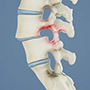 Spondylolisthesis