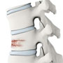 Vertebral Compression Fractures