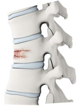 Vertebral Compression Fractures London, UK